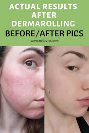 Pin On Derma Rolling Before And After Results
