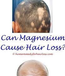 Initially, a thyroid disease can cause dry hair that slowly presents with thinning and coarseness. Is Hair Loss Bad Apple Cider Vinegar Helps Hair Loss Recommended Dose Of Evening Primrose Oil Hair Loss Medication Baldness Solutions Vitamins For Hair Loss