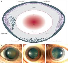 If you have cataracts, it could affect your ability to drive. Supplemental Materials For Cataracts The Lancet