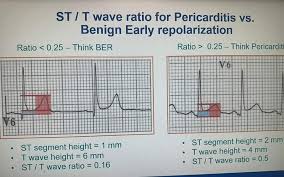 Image result for Early Repolarization