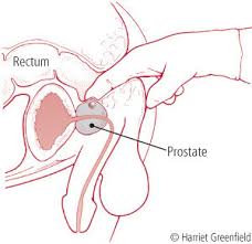 Image result for Prostatitis General Measures