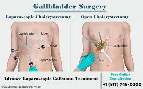 Maybe you would like to learn more about one of these? 5 Signs That You Should Need Gallbladder Surgery Southlake General Surgery