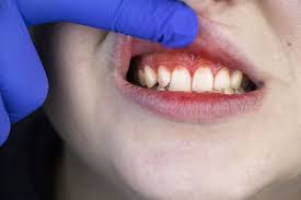 Red or swollen gums, especially on the side. Bleeding Swollen Gums Linked To Severe Covid 19 Cases