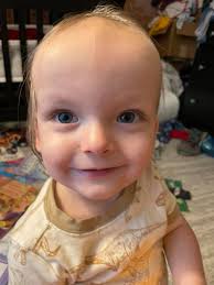 Our turn to share. Since the second day after birth, I was in the hospital  googling why my second child had a ridge down the middle of his head,  something my daughter