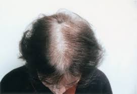 About 50% of men will have some hair loss by the time they turn 50. Androgenetic Alopecia In Women Sciencedirect