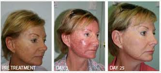 Blue Light Therapy Results Picture Blue Light Therapy Light Therapy Skin Center