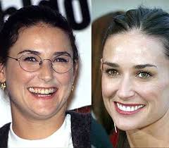 Celebrity Smiles Before And After Celebrity Teeth Celebrity Smiles Smile Makeover