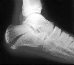 Image result for Calcaneus Compression Fracture