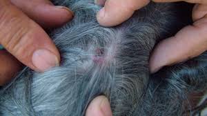 Check spelling or type a new query. Que Hacer Si Te Pica Una Garrapata Las Primeras 24 Horas Son Cruciales