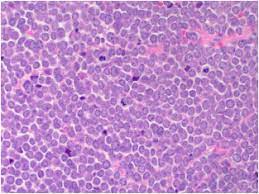 Seronegative patients may have a higher risk of Advances In Merkel Cell Carcinoma From A Pathologist S Perspective Pathology