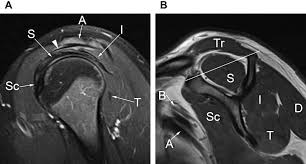 Image result for Shoulder MRI
