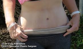 Our surgeons can help you achieve weight loss and live a healthier life. Silicone Strips Do They Help Surgery Scars Coco Ruby Plastic Surgery