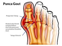 Untuk rawatan melibatkan gangguan makhluk halus/sihir/saka buat rendaman/mandian amalkan sekerap yang mungkin secara berturut turut dan lakukan ulangan dengan. Cara Merawat Gout Dengan Cepat Cara Merawat Gout Dengan Cepat