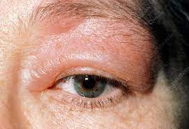 Adult S Swollen Eyelid Due To Insect Bite Allergy Stock Image M320 0127 Science Photo Library