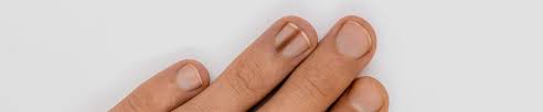 Image result for Acral lentiginous melanoma nail