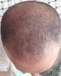 11 Nisan 2016 Serkan Aydin 5700 Greft Sac Ekimi