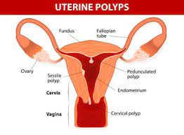Polyps Definition Symptoms Treatments Dr Michal Amir