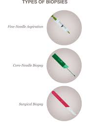 A well differentiated or low grade tumor is slower growing than a poorly differentiated or high grade tumor. Biopsy National Breast Cancer Foundation