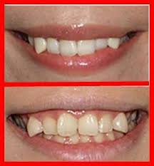 This Is All The Rage In Japan It S Called Snaggletooth If It S Not Done At The Dentist You Can Buy A Grill Japanese Beauty Beauty Trends Beauty