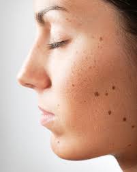 Medically, such beauty marks are generally melanocytic nevus, more specifically the compound variant. Tips To Concealing Unwanted Beauty Marks Sheknows