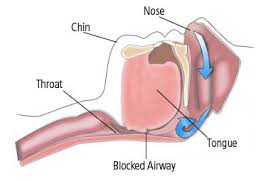 Image result for Obstructive Sleep Apnea