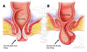 Kết quả điều trị phẫu thuật 205 bệnh nhân ung thư trực tràng tại. Trá»±c Trang La Gi Náº±m á»Ÿ Ä'au Cáº¥u Táº¡o Va Chá»©c NÄƒng