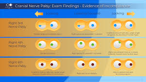 Image result for Pupillary Paralysis