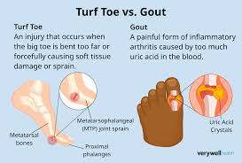 Image result for gout symptoms toe