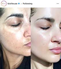 They work so well i'm worried they'll be bought out and disappear because they compete so effectively with cosmetic surgeons and botox, both expensive and ultimately devastating to. Blog Biolite