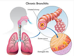 Learn about the differences to better understand their roles in copd. Understanding Chronic Bronchitis And Living Life With Copd Gohealth Urgent Care
