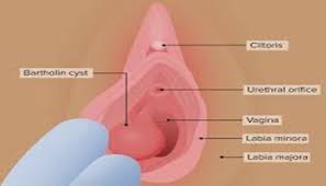 Image result for Bartholin's gland abscess