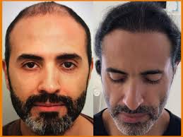 Advanced hair loss restoration with Dr. Patrick Mwamba