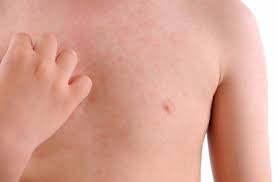 Rouge, les feuilles de l'érable. Urticaire Planete Sante