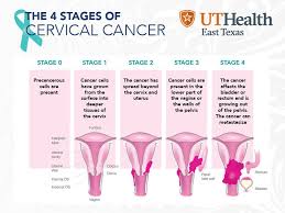 How many meals a day do you have? Ut Health East Texas Cervical Cancer Affects Over Ten Thousand Women In The Us Each Year And Often Shows No Symptoms So How Do You Know If You Re At Risk Everybody S