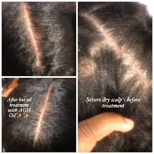 3 Small Natural Hair Oil For Psoriasis And Dry Flaky Scalp Etsy In 2020 Natural Hair Oils Hair Oil Natural Hair Styles