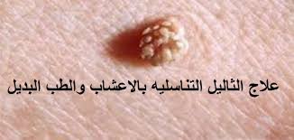 Human papillomavirus infection (hpv infection) is an infection caused by human papillomavirus (hpv), a dna virus from the papillomaviridae family. Ø¨Ø§Ù„Ø§Ø¹Ø´Ø§Ø¨ Ø¹Ù„Ø§Ø¬ Ø§Ù„Ø«Ø§Ù„ÙŠÙ„ Ø§Ù„Ø­Ù„ Ø§Ù„Ø¬Ø°Ø±ÙŠ Ùˆ Ø§Ù„Ù†Ù‡Ø§Ø¦ÙŠ ÙˆØ¹Ù„Ø§Ø¬ Ø§Ù„ØªÙˆØ§Ù„ÙŠÙ„ Ø§Ù„Ø«Ø¢Ù„ÙŠÙ„ Ø§Ù„Ø«Ø¤Ù„ÙˆÙ„ Ø§Ù„ØªÙ†Ø§Ø³Ù„ÙŠ Ø§Ù„Ø³Ù†Ø· ÙÙŠ Ø§Ù„Ø·Ø¨ Ø§Ù„Ø¨Ø¯ÙŠÙ„ Ø¨Ø§Ù„Ø§Ø¹Ø´Ø§Ø¨ Ø¹Ù„Ø§Ø¬ Ø§Ù„Ø«Ø§Ù„ÙŠÙ„ Ø§Ù„ØªÙ†Ø§Ø³Ù„ÙŠÙ‡