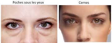 Ajouter à ma liste d'envie. Poches Sous Les Yeux Et Cernes Difference Et Chirurgie Esthetique