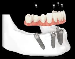 Diamant Dent Dental Medical Institute Startseite Facebook