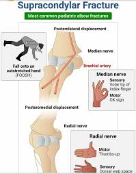 Image result for Fall on Outstretched Hand