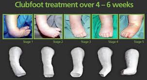 Club foot can't be treated before birth, but picking up the problem during pregnancy means you can talk to doctors and find out what to expect after your baby is born. Ponseti Method For Clubfoot Treatment