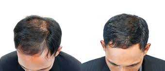 Prp Hair Restoration Magnifaskin Medspa Medical Spa In Wilmington De