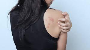 Itchy Bumps On Skin Like Mosquito Bites What Are They
