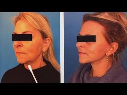 Neck Lifting in Men and Women