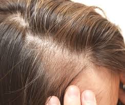 Secondo le statistiche circa il 20% dei giovani intorno ai 20 anni è soggetto ad una precoce (o precocissima) . Quanti Capelli Abbiamo