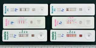 Endemic malaria, population movements, and foreign travel all contribute to the malaria diagnostic problems faced by stipulations for these rapid tests include the capability to detect 100 parasites/μl from all interpretation requires considerable expertise, particularly at low levels of parasitemia (69). Malaria Rapid Diagnostic Tests In Travel Medicine Sciencedirect