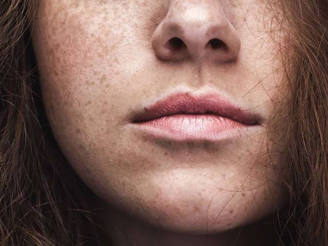 Image result for face freckles",nari