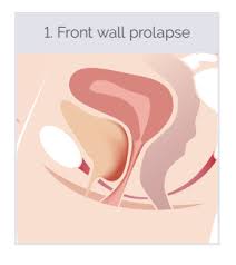 Image result for Urethral Prolapse