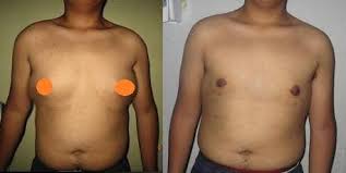 By jaquelinejesus in types > brochures and identidade de gênero população transgênero violência. Mastectomia En Paciente Transgenero Cirugia Plastica Transgenero Peru Dr Wilder Perez Facebook