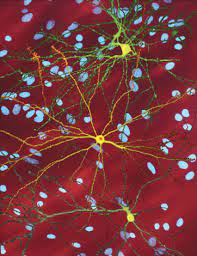 Huntington S Disease Wikipedia