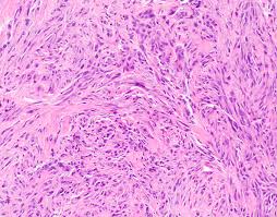 Adenocarcinoma can be challenging to distinguish from malignant mesothelioma in effusions, and this distinction often requires ancillary studies and clinical correlation. Pathology Outlines Diffuse Malignant Mesothelioma